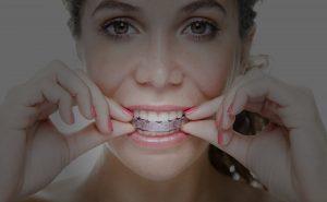 Telsiz Ortodonti - Invisalign