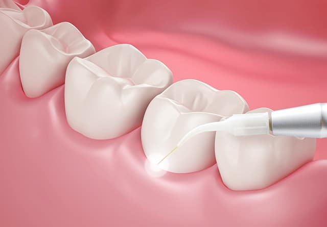 Diş Hekimliğinde Diyot Lazer Uygulamaları