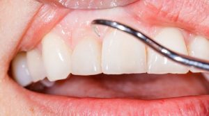 Diş Eti Tedavileri