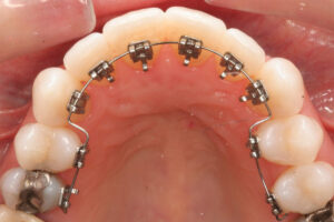 Lingual Ortodonti